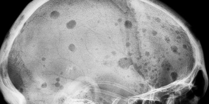 03HS-myeloma-mediumSquareAt3X-lvgOKe-rss