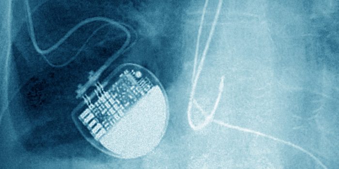 05-HS-pacemaker2-mediumSquareAt3X-oOfQ8y-rss