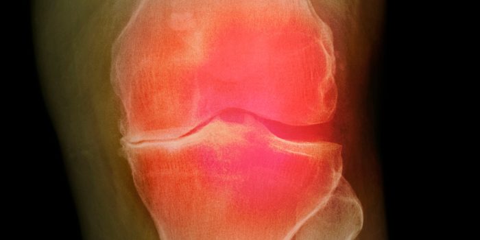 06HS-arthritis-mediumSquareAt3X-Up4r2e-rss