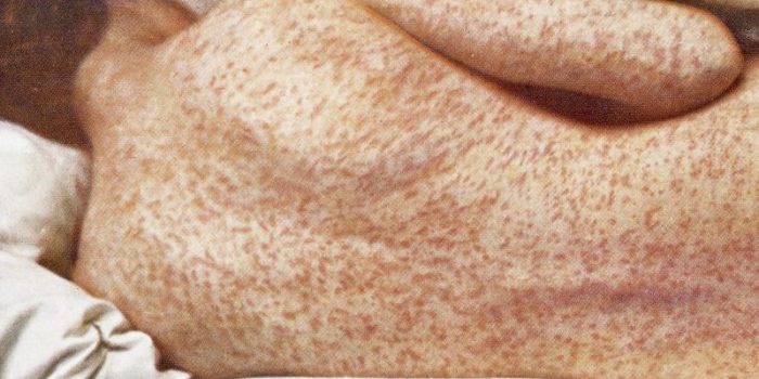 Back_of_female_with_measles_Wellcome-flBbOD-rss