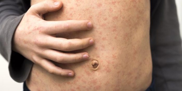 Child20with20measles20rash-1RrmC5-rss