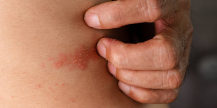 Itchy20rash-dBV5bH-rss