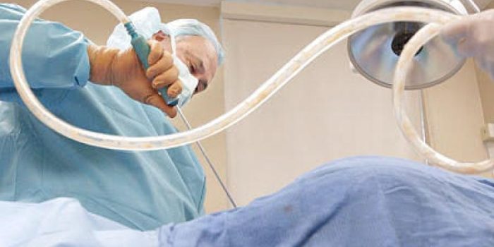Liposuction-GOfVPG-rss