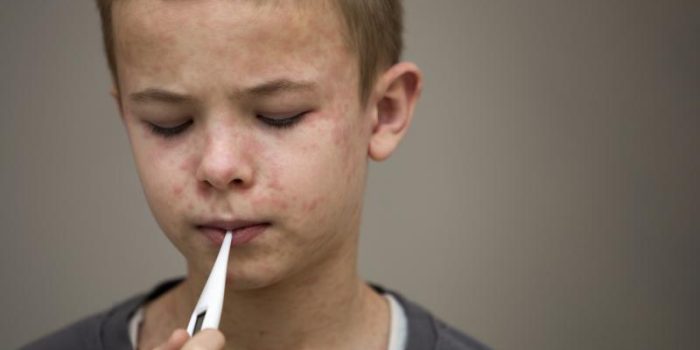 boy20with20measles2028429-cIJZfi-rss