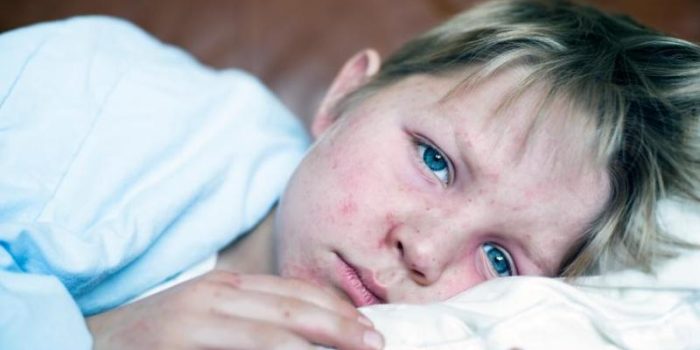 boy_with_measles-YvsL8i-rss