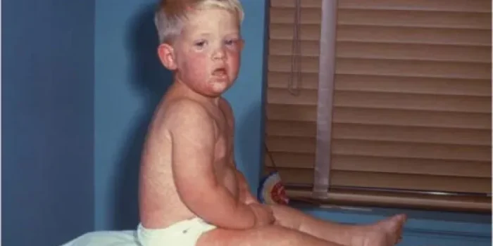 measles-21-lg-wiiirt-rss