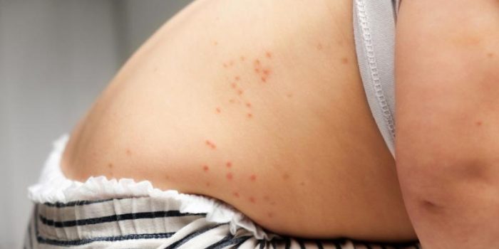 measles20child20back-8EyqTT-rss