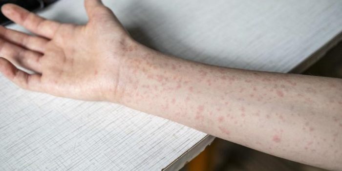 measles20rash20on20arm20281292028129-ZdVBrA-rss