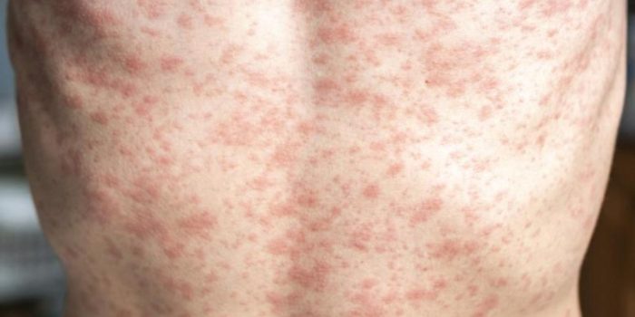 measles20torso2028329-MDQuQM-rss