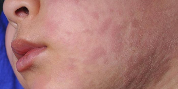 measleschild2028529_0-C1F1G4-rss