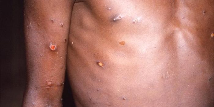 mpox20lesions_020281292028229-d9sM4O-rss