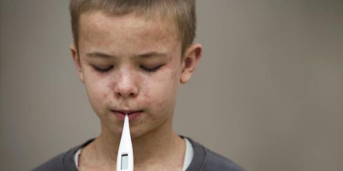 young20boy20measles20fever_0-RI9qWa-rss