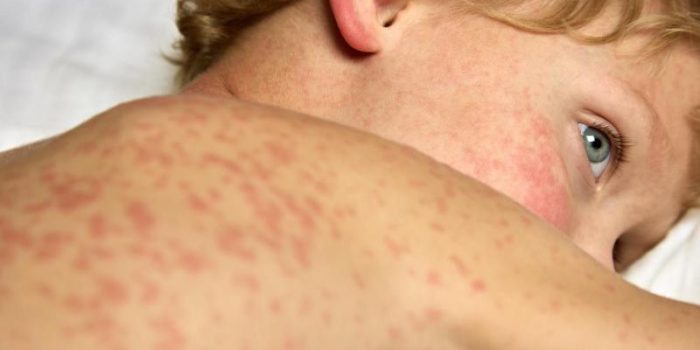young20boy20with20measles_0-xzX7mM-rss
